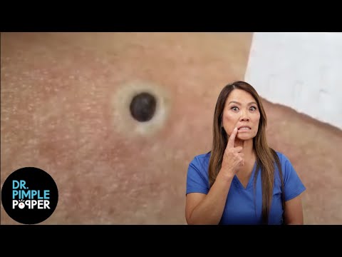 85 Year Old Blackhead! Dr Pimple Popper Most Popular Pop of ALL TIME!