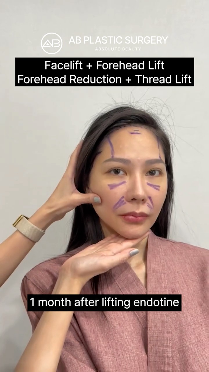 Korean Facelift Made My Face Tiny #shorts