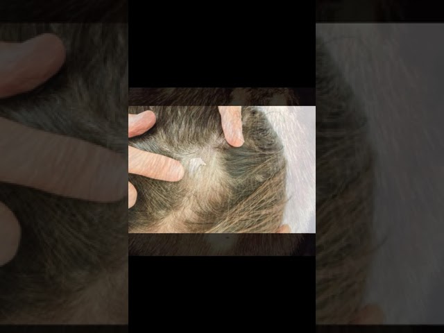 Стригущий лишай грибковые заболевания кожи