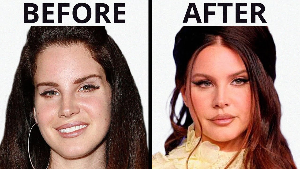 Lana Del Rey's SHOCKING Transformation | Plastic Surgery Analysis