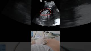 Ultrasound showing boy baby with chord around its neck ? : Ultrasound case shorts