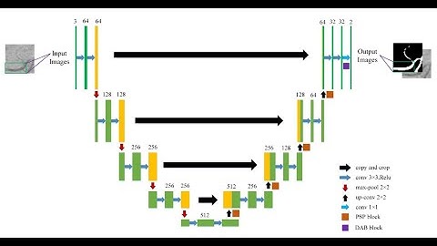 Video abstraction: An improved U-Net model with multiscale fusion for retinal vessel segmentation