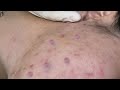 Acne Treament Under The Skin #042