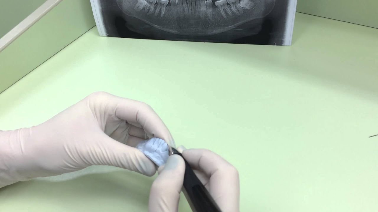 Антонина Фартушна. Непрямая фиксация вестибулярных брекетов. Часть #1 ...