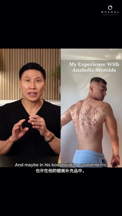 Dr Thean Reacts Does Anabolic Steroids Cause Acne Ensoul Medical dr-thean-reacts-does-anabolic-steroids-cause-acne-ensoul-medical