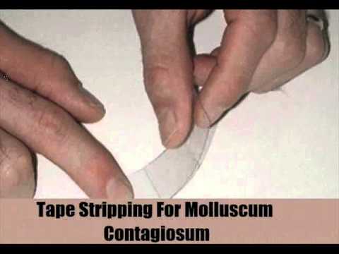 Molluscum Contagiosum Natural Home Remedy Molluscum Contagiosum Natural Home Remedy