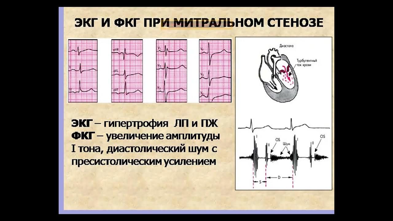 Митральный аортальный стеноз. Стеноз митрального клапана ЭКГ. ЭКГ при стенозе митрального клапана. ЭКГ признаки митрального стеноза. Изменения на ЭКГ при митральном стенозе.