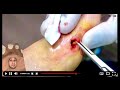 CRAZY FOOT OBJECT REMOVAL ***UNBELIEVABLE*** #toebroclip