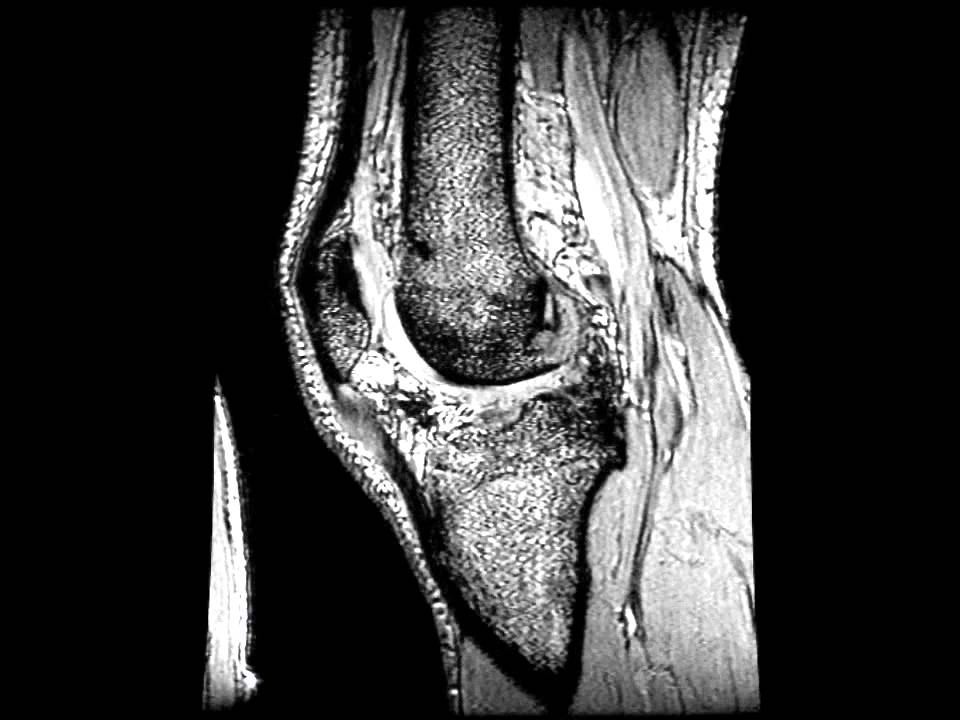 Lesión del ligamento cruzado anterior