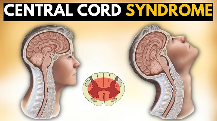 Central Cord Syndrome: Is Your Neck Pain Hiding Something More Serious?
