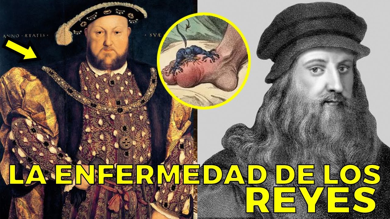 La Historia de la Gota: LA ENFERMEDAD DE LOS REYES - YouTube