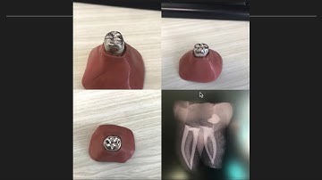 Cuspal Coverage Amalgams - Why we do them........