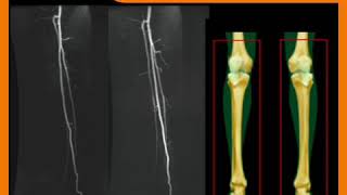 Bilateral lower extremity dynamic MRA using SWIFT