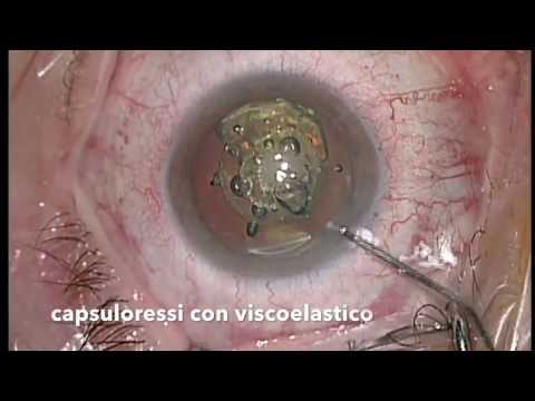 Video: Cheratotomia Astigmatica Laser Assistita Da Femtosecondi: Una Revisione