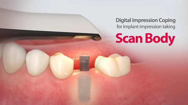 Digital Impression Coping for implant impression taking "ScanBody"