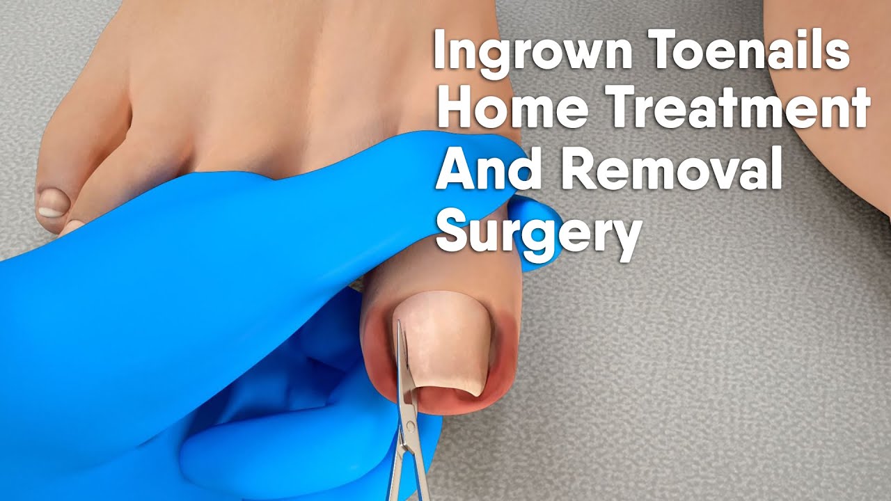 Ingrown Toenail Treatments