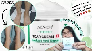 Aliver Scar Cream|fast & effective result|sulosyon sa malalang peklat ng anak ko|insect bite Kasi?