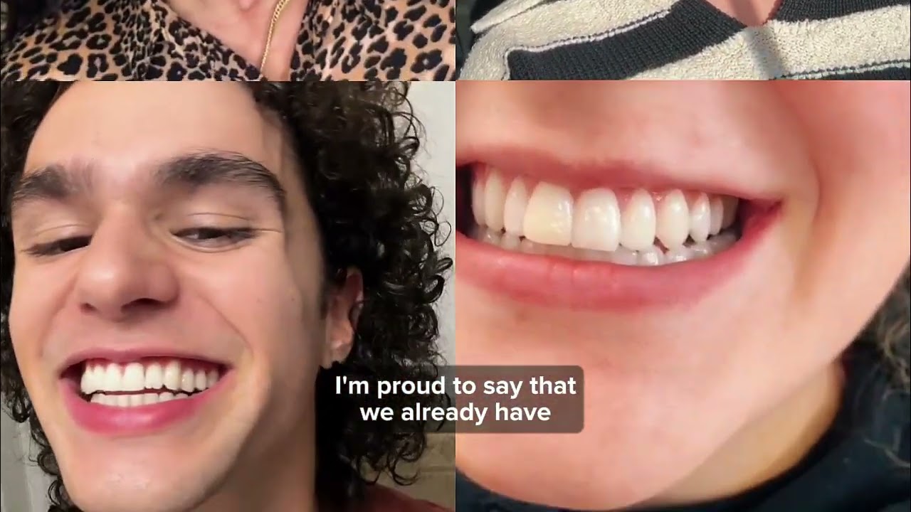 Shiny Smile Veneers Reviews 2026 | Are These Removable Veneers Really Worth Buying?