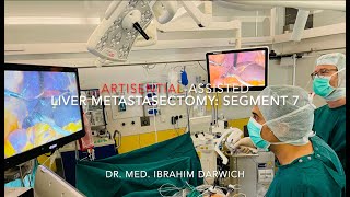 Laparoscopic ArtiSential assisted Metastasectomy in Segment 7 of the Liver