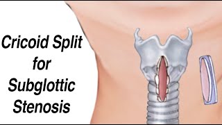 Cricoid Split to Treat Infant Subglottic Stenosis