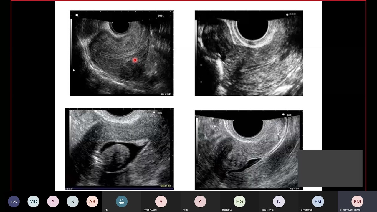 #Gynéco | 26.Fibrome utérin (Dr Merrouche Naoual)