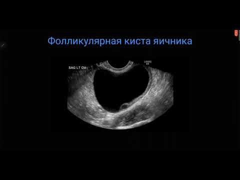 Video: Unilocular киста деген эмне?