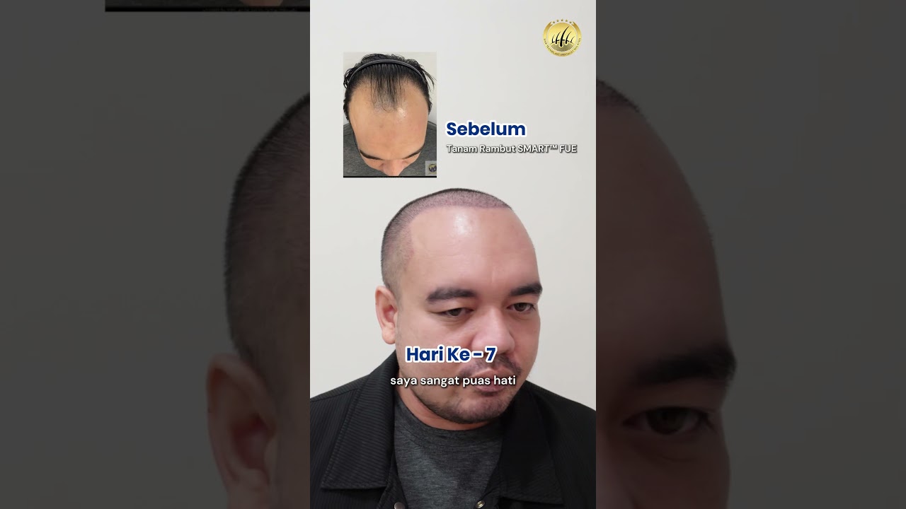 Glojas Specialist Clinic | Mantap! Hasil Tanam Rambut! #hairtransplantmalaysia