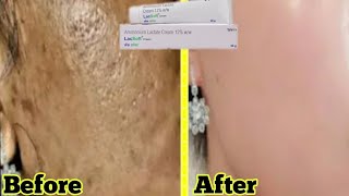 Lacsoft Cream | Remove Pigmentation | Dark spot | Acne & Acne scars | Brijwasi Girl screenshot 2