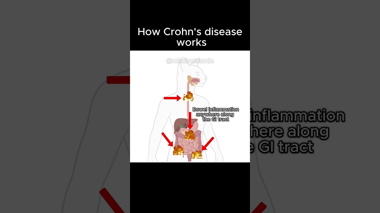 HOW CROHN'S DISEASE WORKS