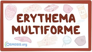 Erythema multiforme  causes, symptoms, diagnosis, treatment, pathology