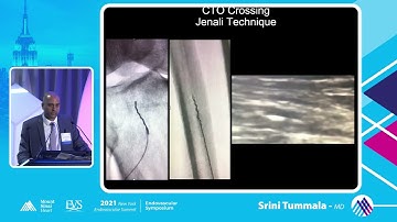 Algorithm for Femoral Popliteal CTO Crossing - Srini Tummala, MD