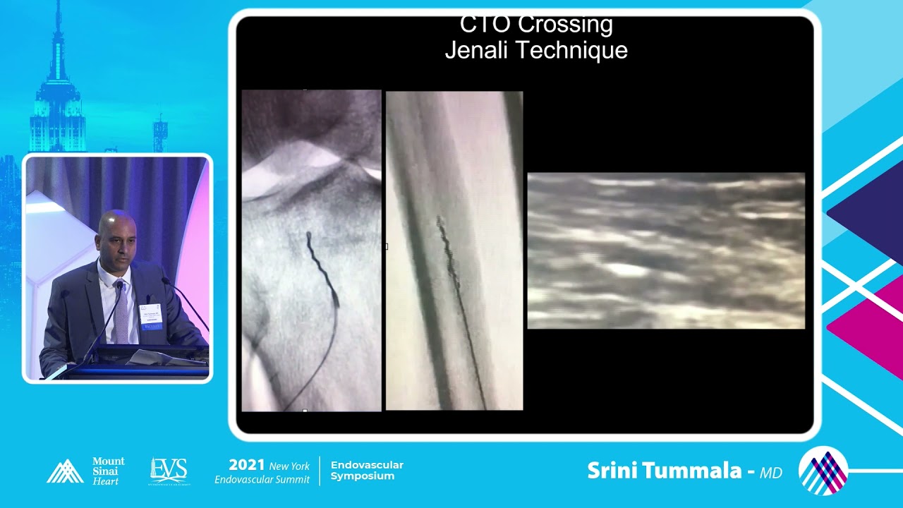 Algorithm for Femoral Popliteal CTO Crossing - Srini Tummala, MD