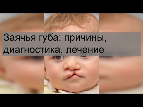 Заячья губа: причины, диагностика, лечение