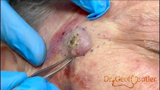 Removal of a Squamous Cell Cancer on the face