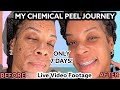 How I Cleared My Acne & Hyperpigmentation In 7 DAYS| Chemical Peel- Skin Care Routine 2022.