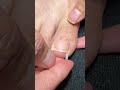 Ingrown Toenail Correction Foot Care Nail Treatment Shorts