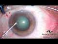 Painless cataract surgery  in 330 minutes unedited  sharp sight eye hospital