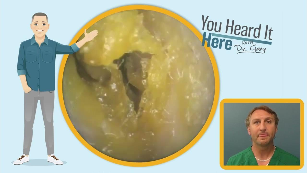 Collapsing ear canal, what’s that? YouTube