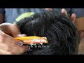 OMG!! Dandruff Scratching!! | Help Removal Big Flakes Dry Scalp From Head #204