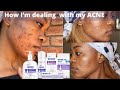Benzoyl Peroxide (Benzac AC) for ACNE: 3 weeks update || My experience || South African Youtuber