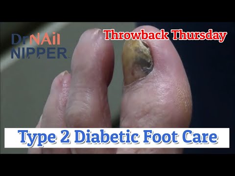 Video: Diabetická Noha - Příznaky, Léčba, Příčiny