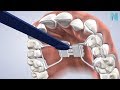 Palatal Expander in Fresno CA: Dr. Greg | Nalchajian Orthodontics