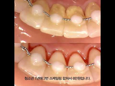 청소년 충치를 예방하는 4가지 방법