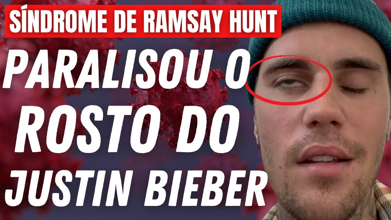 SÍNDROME DE RAMSAY HUNT: TUDO SOBRE A DOENÇA DO JUSTIN BIEBER | Dr ...