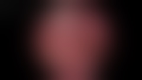 Sphenopalatine artery ligation , cauterization and introduction to posterior nasal neurectomy