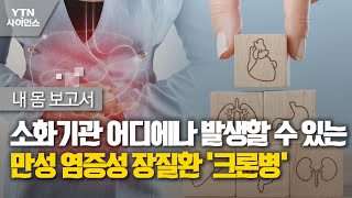 [내 몸 보고서] 소화기관 어디에나 발생할 수 있는 만성 염증성 장질환 &#39;크론병&#39; / YTN 사이언스