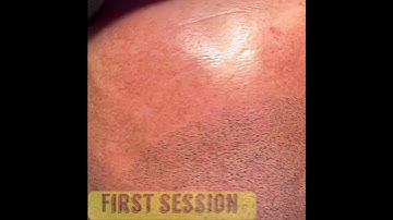 Head tattoo #smp #scalpmicropigmentation first session