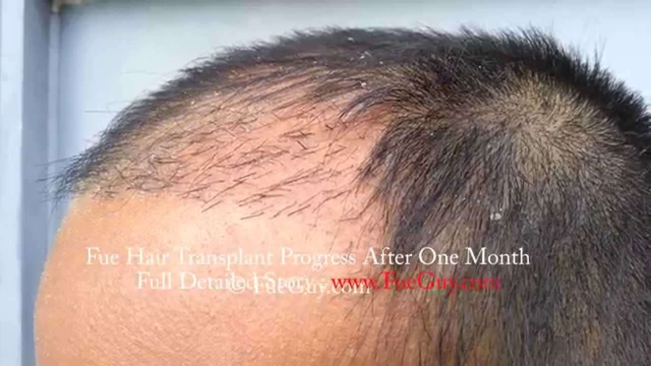 New Hair Growing After One Month Of Fue Hair Transplant New Hair Growing After One Month Of Fue Hair Transplant