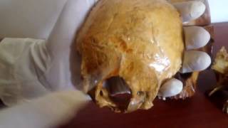 Anatomy - Occipital Bone Practice (Squama, Basilar Portion, Condyles)