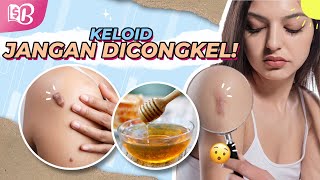 Solusi! Hilangkan Keloid dengan Cara Alami dan Medis